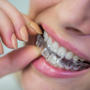 INVISALIGN INVISALIGN